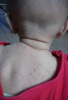 宝宝长痱子哭闹不停,宝宝一哭就起痱子怎么办