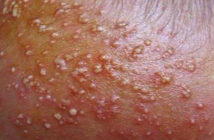 宝宝长痱子哭闹不停,宝宝一哭就起痱子怎么办