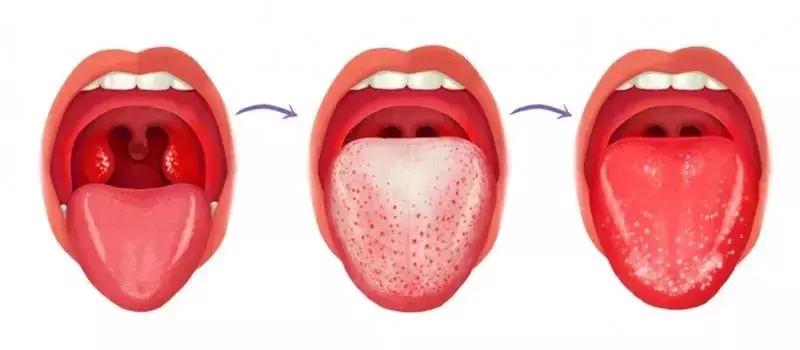 小儿手足口症状和治疗方法,小儿手足口最早期要怎么治疗