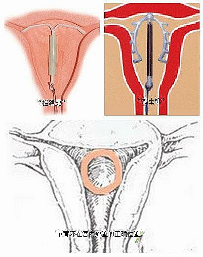 你的子宫在哪个位置是正常的,子宫里面淤血怎么更快排干净