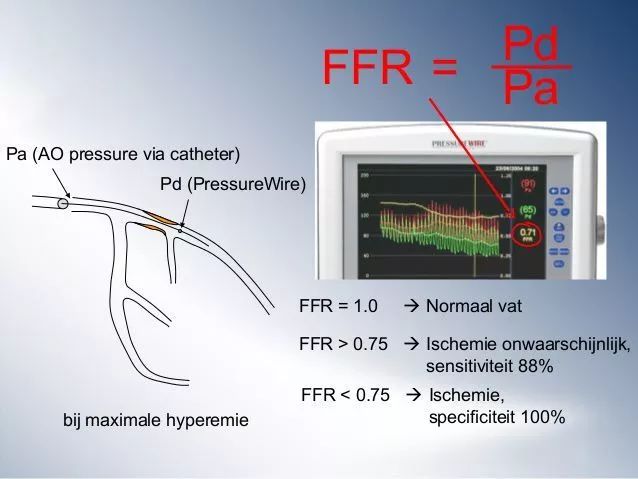 要不要放支架听专业人讲,要不要放支架