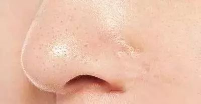 好物去黑头祛痘,去黑头粉刺面霜