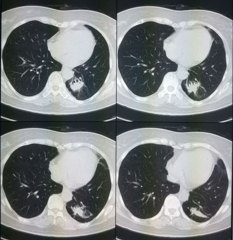 肺结节肺癌早期手术了会没事吧,肺结节肺癌早期手术能活多久