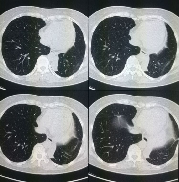 肺结节肺癌早期手术了会没事吧,肺结节肺癌早期手术能活多久