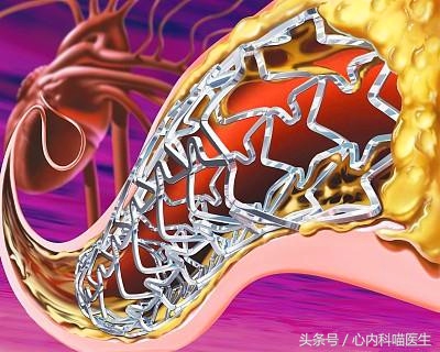 心绞痛需要放入支架吗,心绞痛要不要放支架