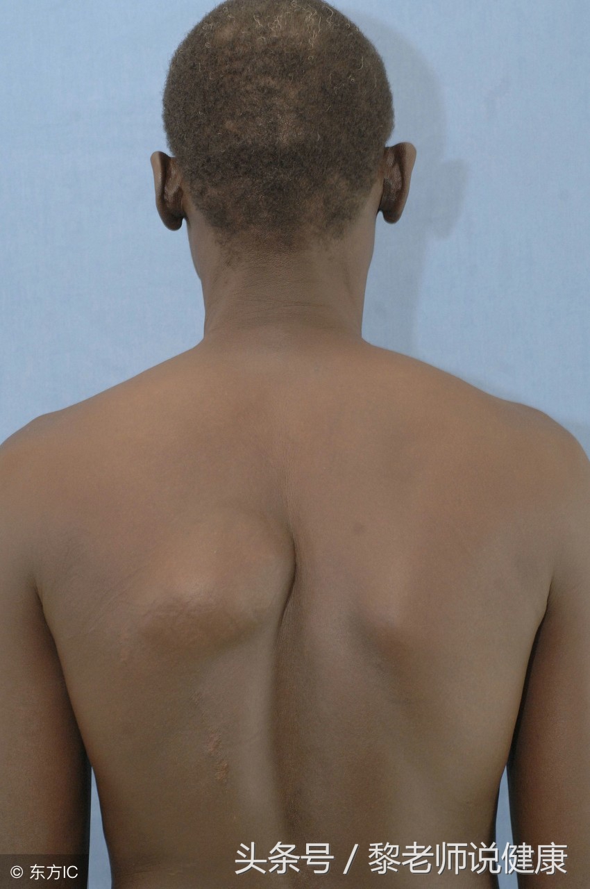 长了好几个皮下脂肪瘤,长了4年的脂肪瘤居然恶化了