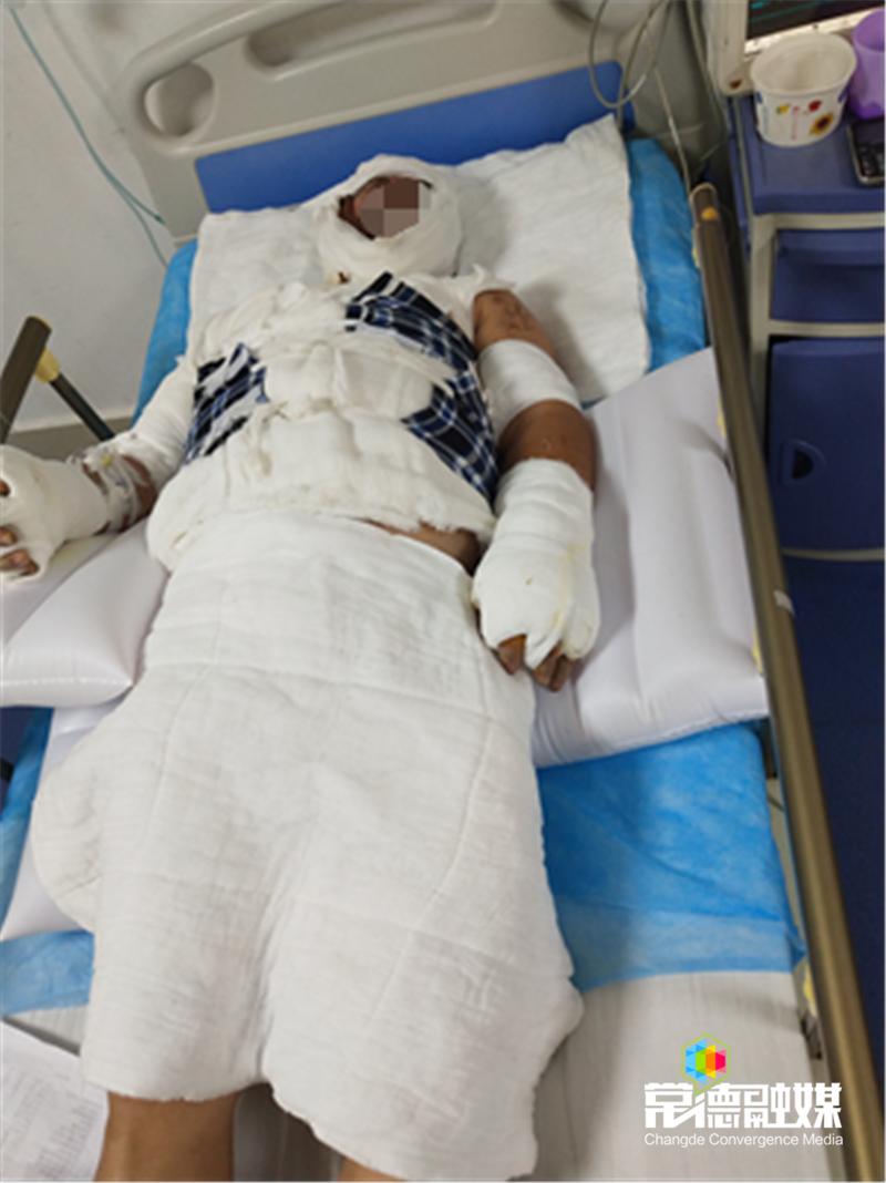 一家7人端午聚会5人烧伤独生女计穷力竭盼帮忙