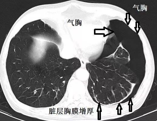 这样的气胸不少见,胸腔穿刺需谨慎!