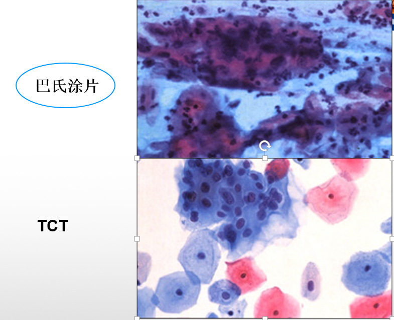宫颈癌预防检查哪几项,打预防宫颈癌的针需要做什么检查