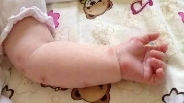 店员经典培训教材：蚊虫叮咬的药物推荐和联合用药