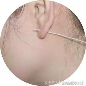 为什么打耳洞臭臭的,刚打的耳洞流黄水臭臭的怎么办