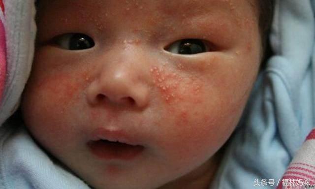宝宝湿疹和痱子怎么区别,宝宝得了湿疹痱子解决方法