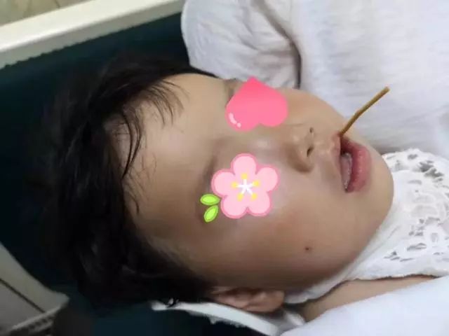 揪心！13厘米竹签插入两岁娃嘴里生命垂危！做家长的千万要注意！