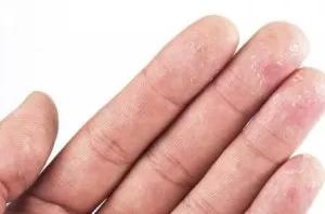 一到夏天脚上总起水泡,一到夏天脚上就长水泡是湿气重么