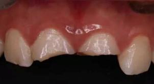 怎么拯救牙齿最快最有效,如何拯救牙齿