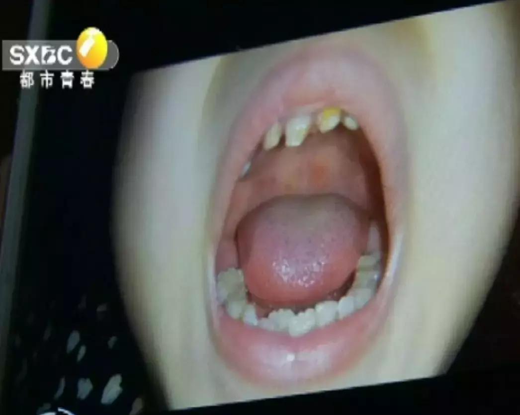 幼儿园手足口病会致人死亡吗,幼儿园因手足口病通知患者家长