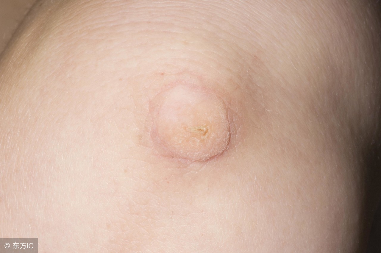 怎样预防寻常疣传染给孩子,怎样预防寻常疣的发生