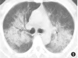 肺水肿和左心衰如何鉴别诊断,蝶翼征