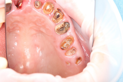 不能随便拔牙的原因,不能拔牙但是牙坏了怎么办