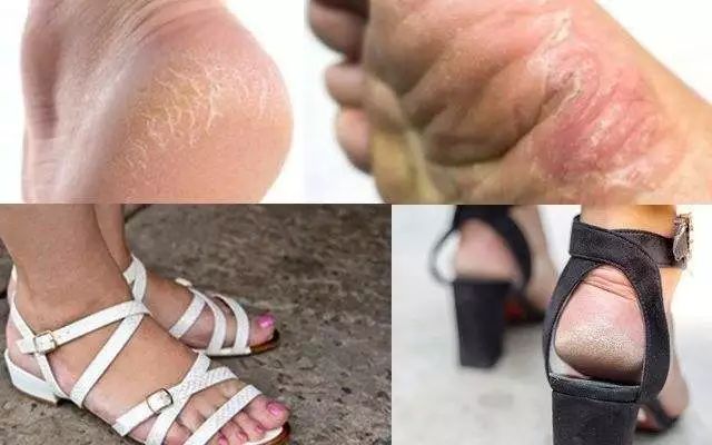 脚气脚臭有救了！有了这块韩国嫩足皂，轻轻一洗，杀菌治脚气，告别瘙痒，连死皮都不见了