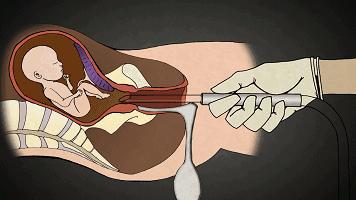 无痛人流真的无痛吗,无痛人流真是一点都不痛吗