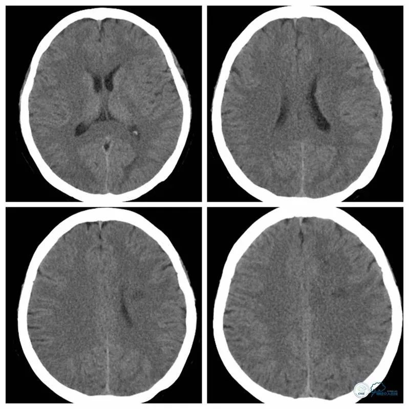 大脑中动脉支架术后再狭窄的几率,天坛医院介入脑血管手术