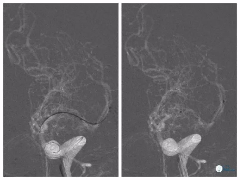 大脑中动脉支架术后再狭窄的几率,天坛医院介入脑血管手术