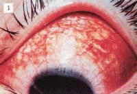 超急性细菌性结膜炎首选药物,医生是怎么治疗急性结膜炎的