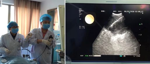 肺癌合并肺纤维化治疗,肺栓塞患者合并肺癌