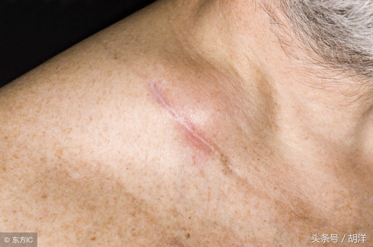 如何区别淋巴结肿大与癌症,咽喉炎和淋巴结肿了看哪一科