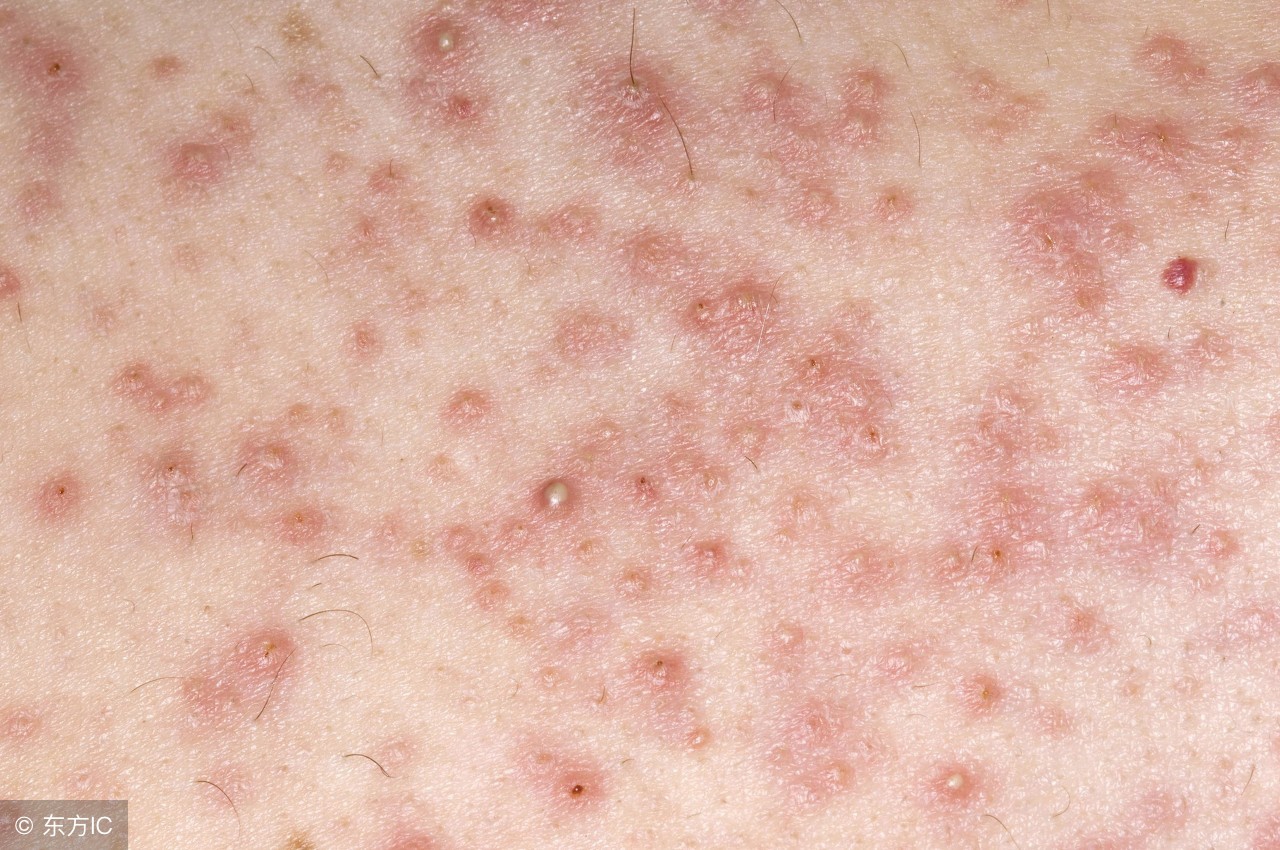 毛囊炎怎么知道严不严重,后脑勺长疙瘩毛囊炎怎么预防