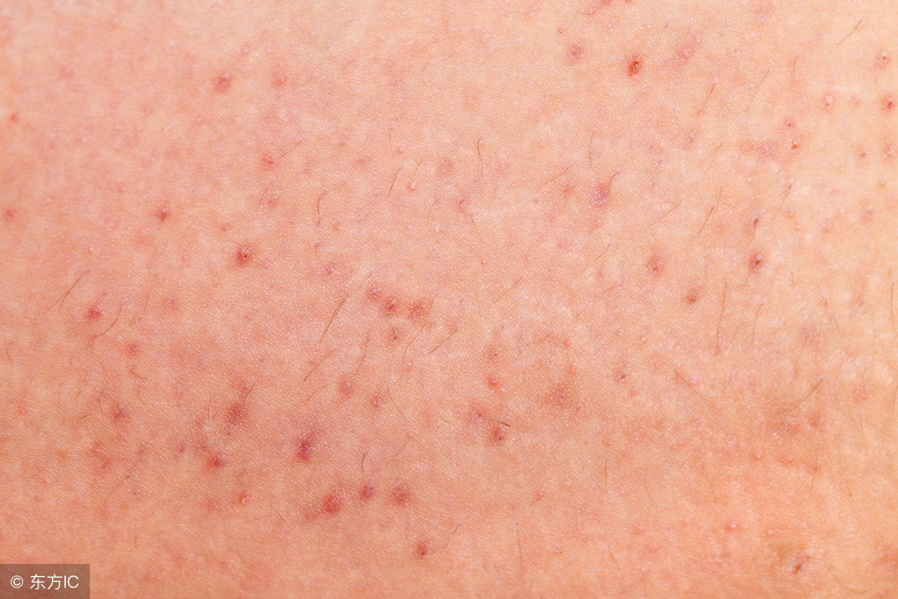 毛囊炎怎么知道严不严重,后脑勺长疙瘩毛囊炎怎么预防