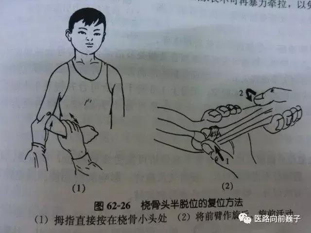 比较少见的脱位,小儿肘关节脱位最常见的脱位分类