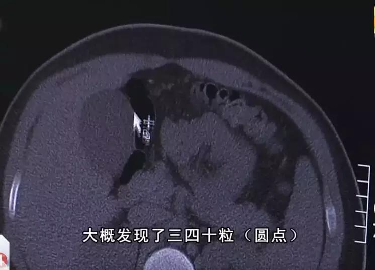 19岁男孩喝珍珠奶茶后腹痛,喝珍珠奶茶ct显示胃里有白点