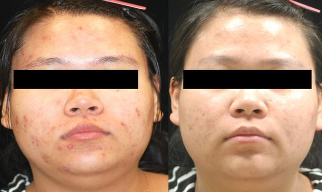 颜悦课堂洗脸可以祛痘吗,颜悦课堂的真实案例