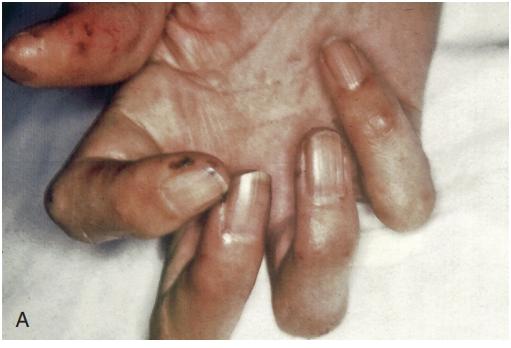 类风湿手关节炎有针刺感,类风湿关节炎全身骨头针扎样疼