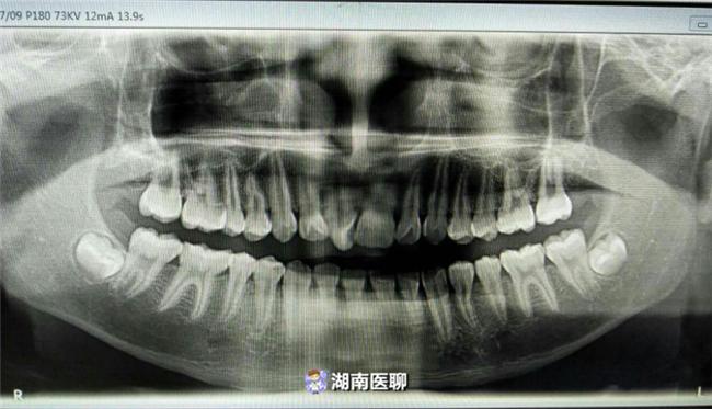 7岁孩子牙齿正畸的真实感受,牙套的诱惑