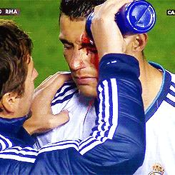 c罗的眼角被撞血流如注,眼角被撞一道口子