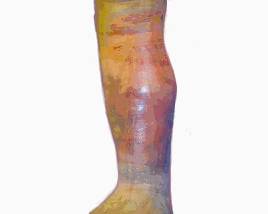 「杏林微科普」暴雨天，外出蹚水淋雨，小心得了脉管炎！