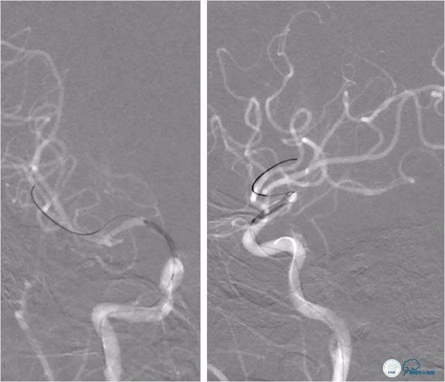 天坛脑血管动脉瘤介入手术,天坛医院脑动脉狭窄