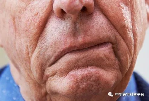 高血压停药的危害,高血压带来的危害有哪些