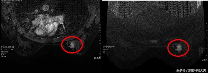 b超和钼靶检查肿瘤大小不一样,b超和钼靶肿块大小不一样