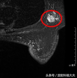 b超和钼靶检查肿瘤大小不一样,b超和钼靶肿块大小不一样