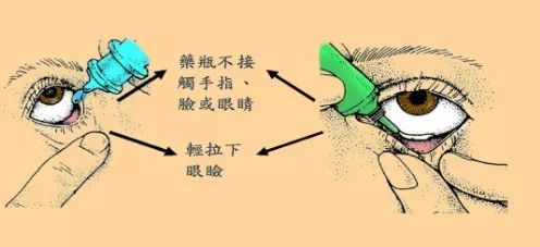 打开1个月的滴眼液还在滴？滴眼液直接滴在眼球？你真的会用么？