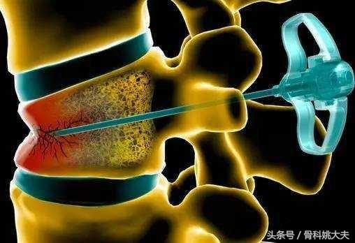 骨折了疼痛难忍怎么办,骨折处疼痛怎么减轻