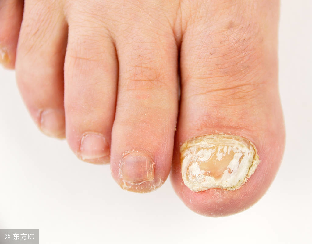 严重的灰指甲的危害到底有多大,灰指甲有没有致命危险