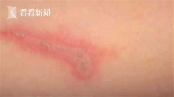 被蚂蚁咬伤致命事件,被蚂蚁咬伤的人有哪些表现