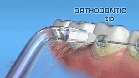 看牙太贵还不是因为你怕遭罪,不整牙有必要买冲牙器吗