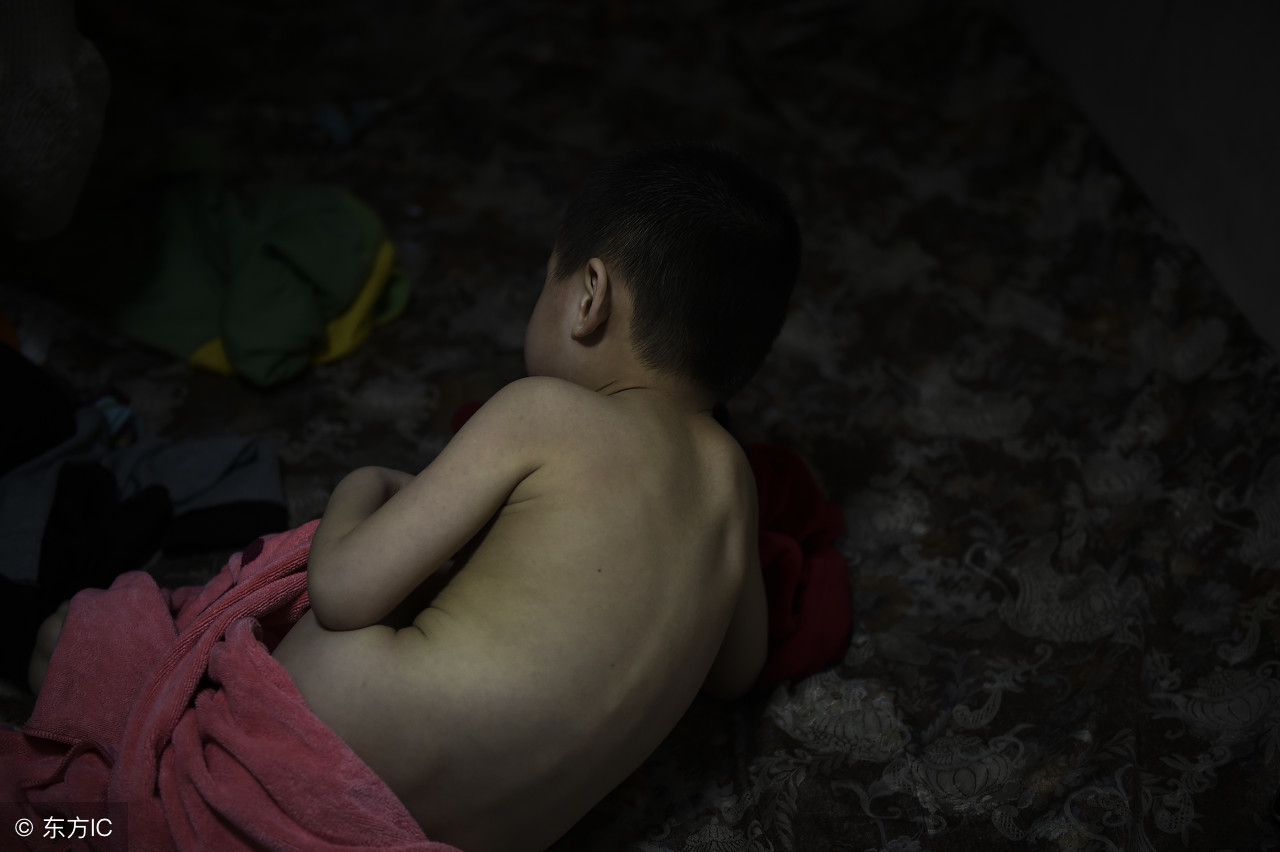 阴囊湿疹夏季高发,3个小方法让你不在害怕它