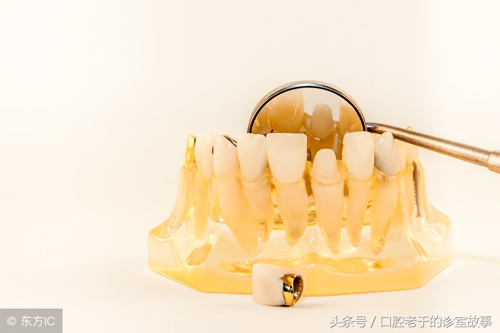 烤瓷冠什么样的最好,烤瓷冠大概多少钱一颗